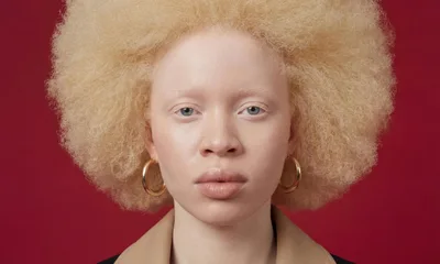 Portrait Of A Young Woman With Albinism