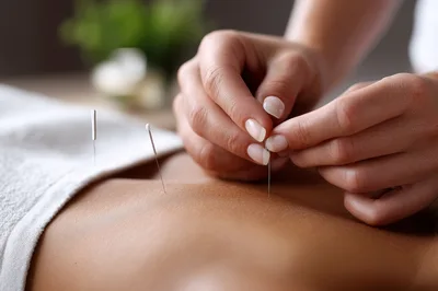 Acupuncturist Performing Treatment On A Patient Back