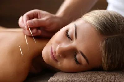 Acupuncture Treatment On A Woman's Back