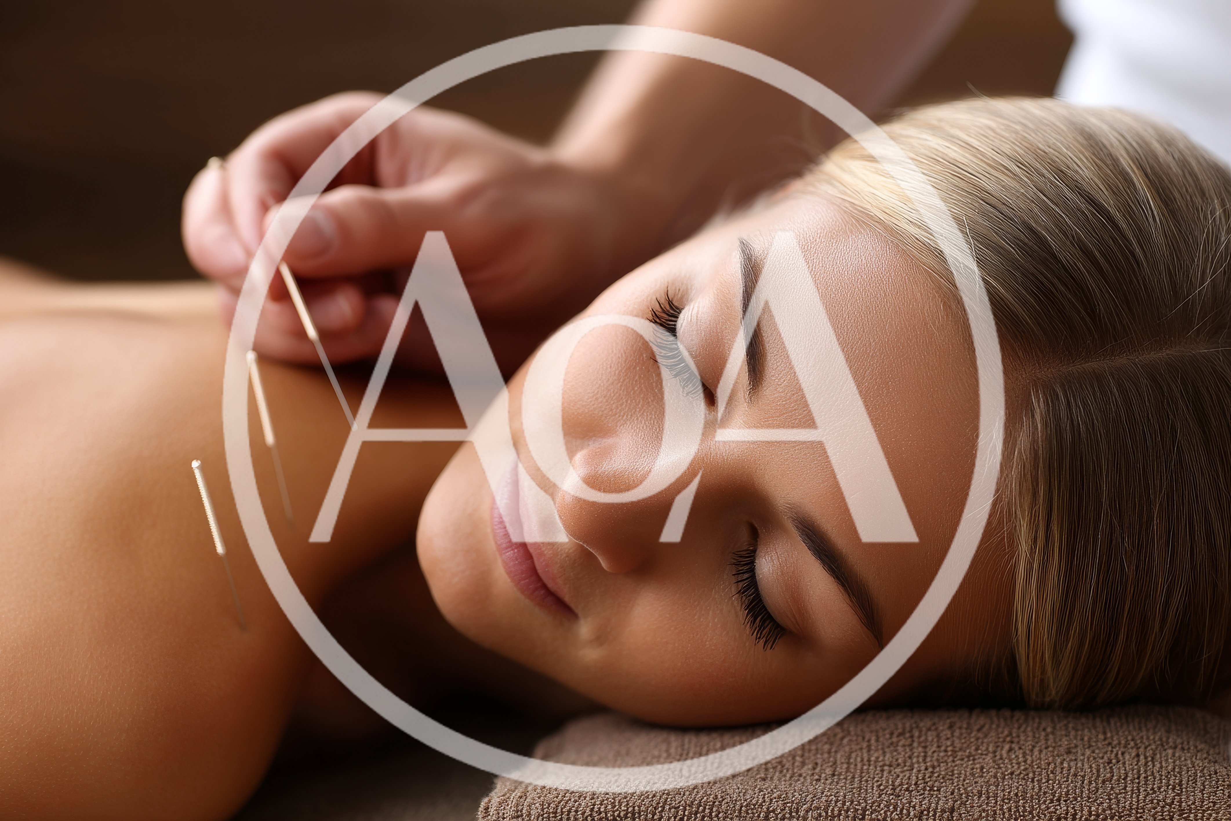 Acupuncture Treatment On A Woman's Back