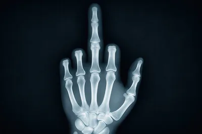 X-Ray Image Of A Hand Giving The Middle Finger