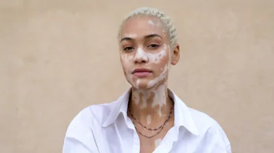 Portrait Of A Young Woman With Vitiligo
