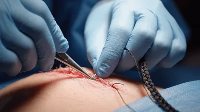 Surgeon Suturing Surgical Incision During Medical Procedure