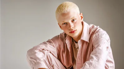 Portrait Of A Young Man With Albinism