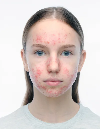 Portrait Of A Young Girl With Severe Facial Acne