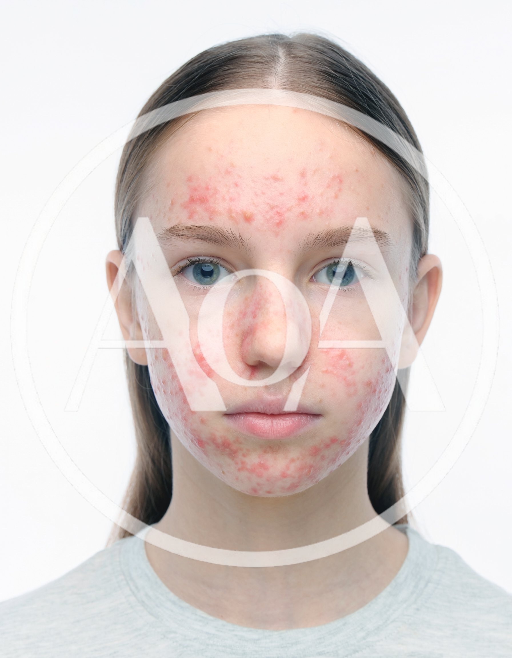 Portrait Of A Young Girl With Severe Facial Acne