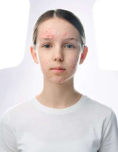 Portrait Of A Young Girl With Acne