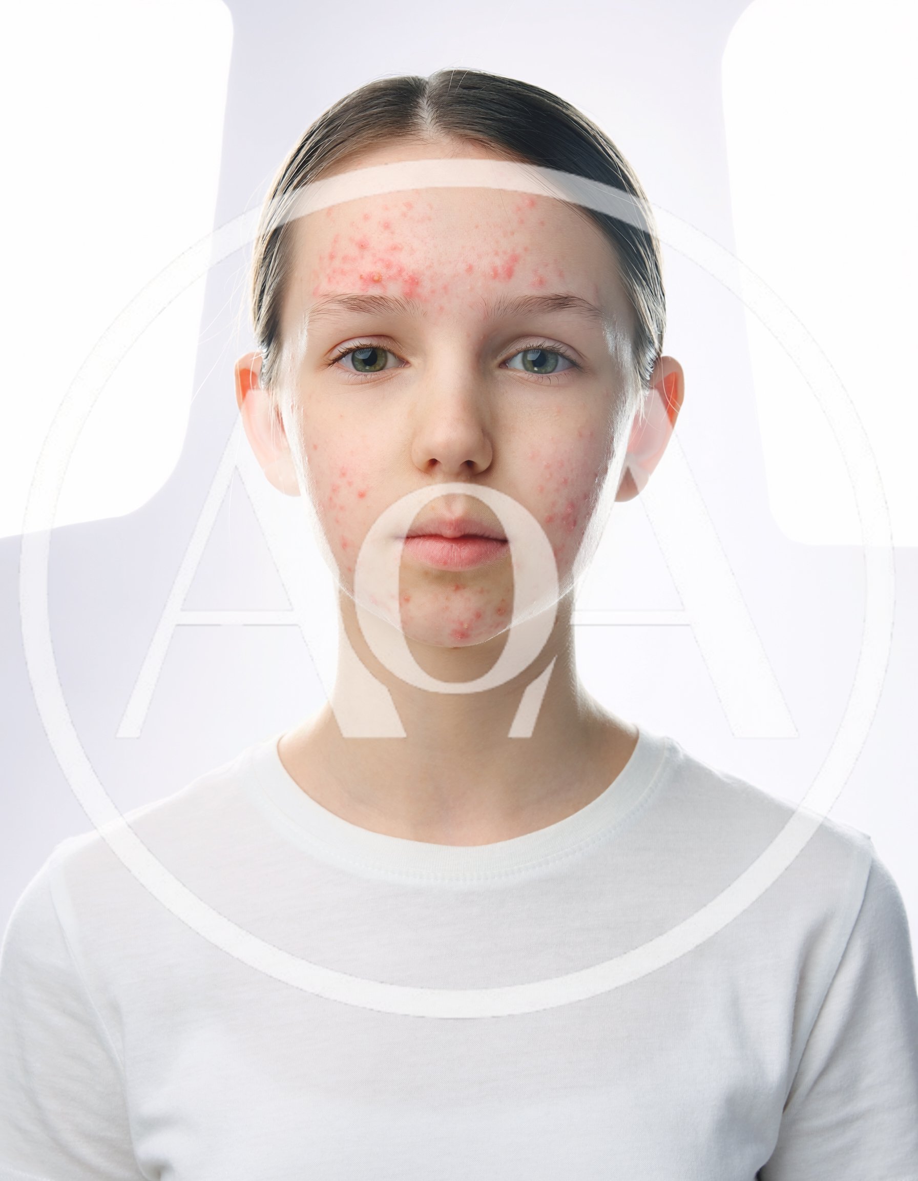 Portrait Of A Young Girl With Acne