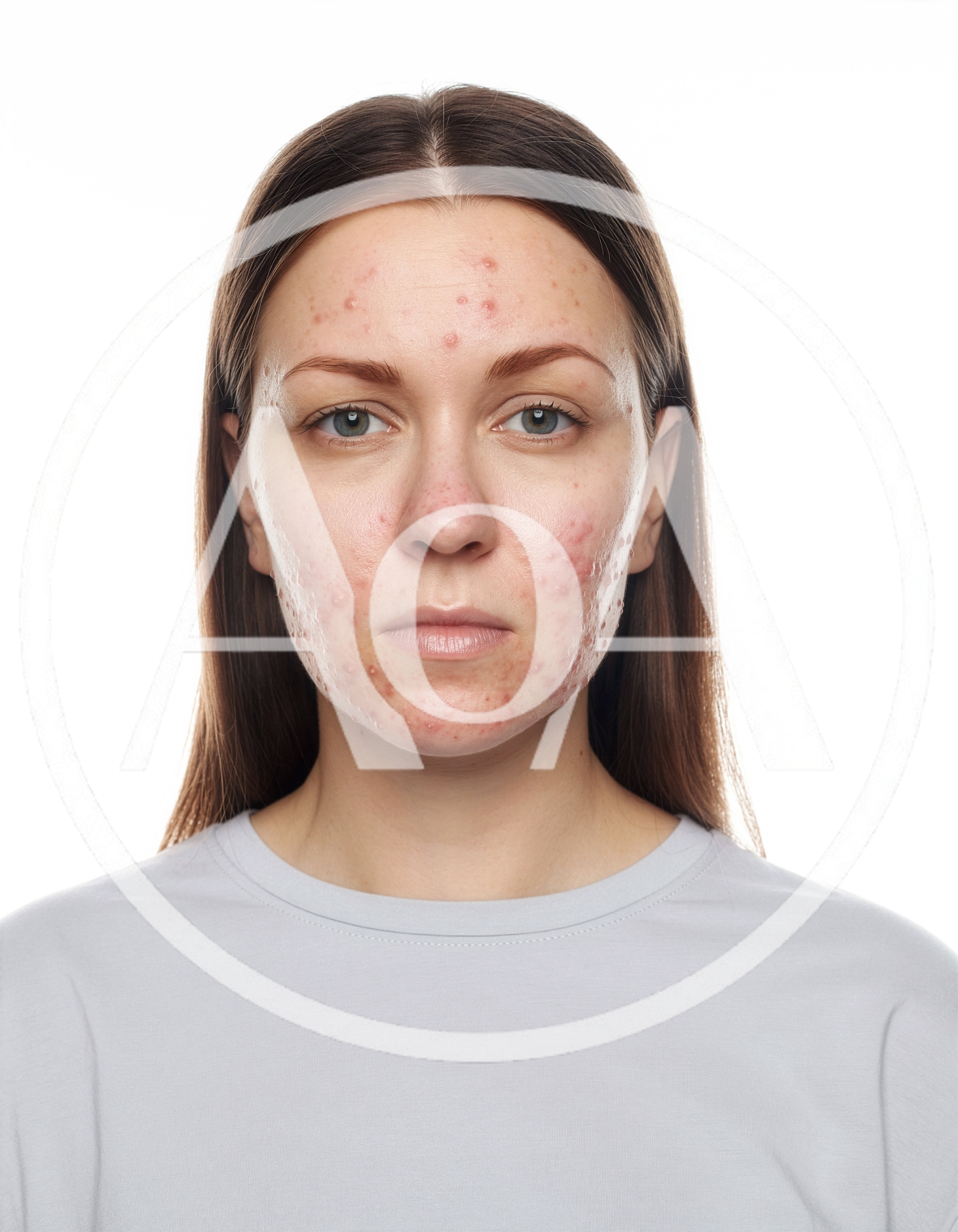 Portrait Of A Young Woman With Acne Prone Skin