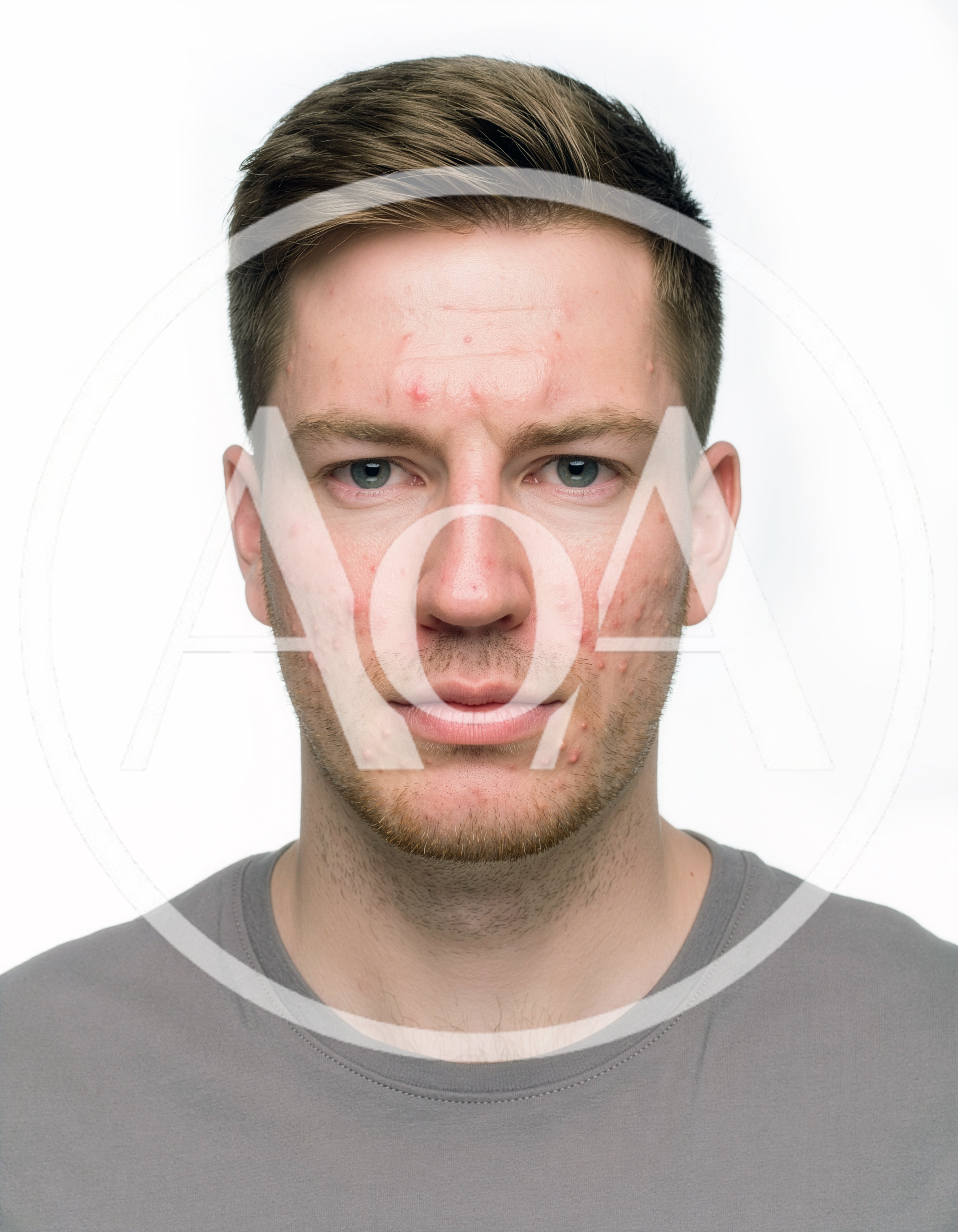 Portrait Of A Young Man With Acne